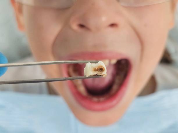 Best Urgent Tooth Repair  in Archbold, OH